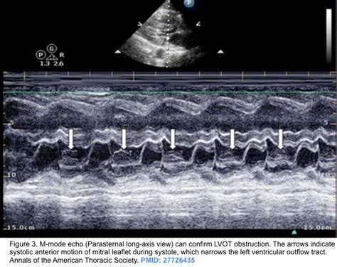 dynamic lv outflow obstruction